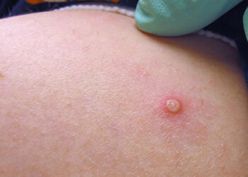 Bộ Y tế chỉ đạo khẩn sau khi TP HCM phát hiện ca bệnh đậu mùa khỉ