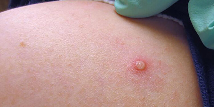 Bộ Y tế chỉ đạo khẩn sau khi TP HCM phát hiện ca bệnh đậu mùa khỉ